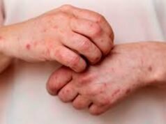 Argentina suma 3 nuevos casos de Mpox y alcanza un total de 11