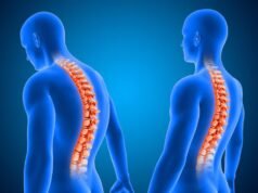 Escoliosis: Deporte y chequeos, claves para el desarrollo saludable de los jóvenes
