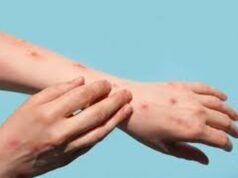 Mpox: siguen sin cambios los casos confirmados en Argentina