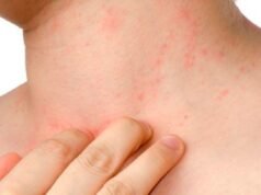 La dermatitis atópica en la infancia: un predictor de asma y alergias futuras