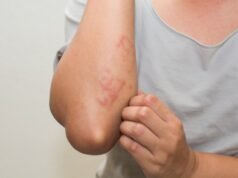 Dermatitis atópica: un desafío constante en la vida diaria