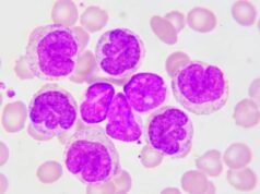 La mayoría de los pacientes con leucemia linfocítica crónica desconoce sus síntomas