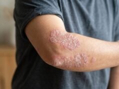 La psoriasis: una enfermedad que va más allá de la piel