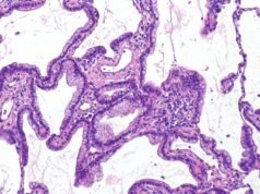 Todo sobre el adenocarcinoma pulmonar: síntomas, causas y tratamientos